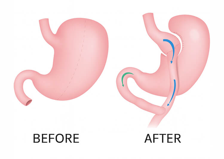 Gastric bypass -Pax Medicus | Medical Tourism Agency