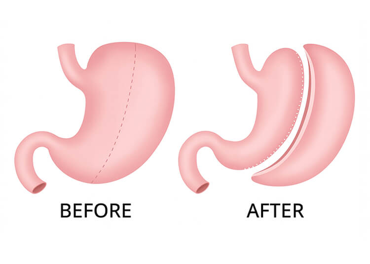 Sleeve Gastrectomy Before and After
