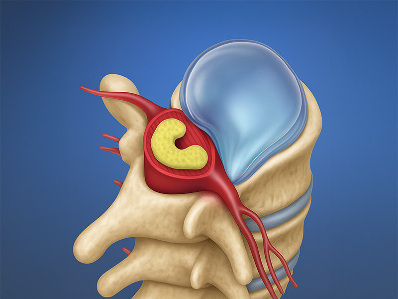 Intervertebral Disc Herniation Surgery