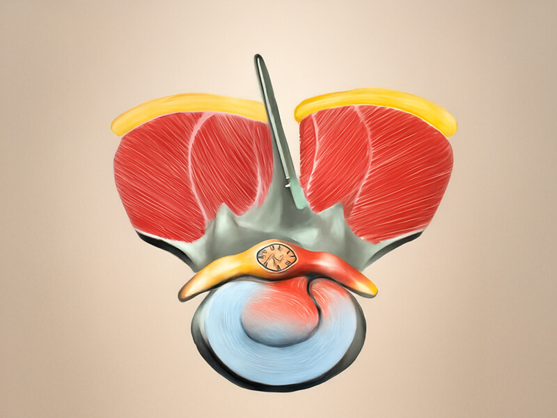 Microdiscectomy