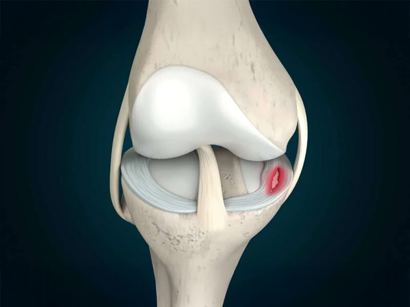 Arthroscopic Meniscus Repair | PAX Medicus Medical Tourism
