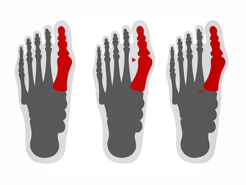 Hallux Valgus Surgery (Bunion Surgery) | PAX Medicus Medical Tourism UK