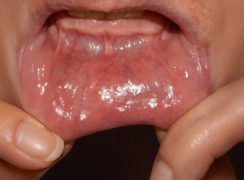 Healed lip | PAX Medicus Medical Tourism Agency