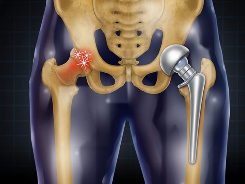 Hip Joint Surgeries | PAX Medicus Medical Tourism UK
