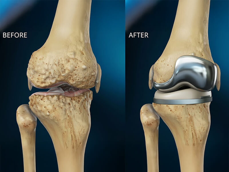 Knee Arthroplasty (Knee Replacement Surgery) | PAX Medicus Medical Tourism UK