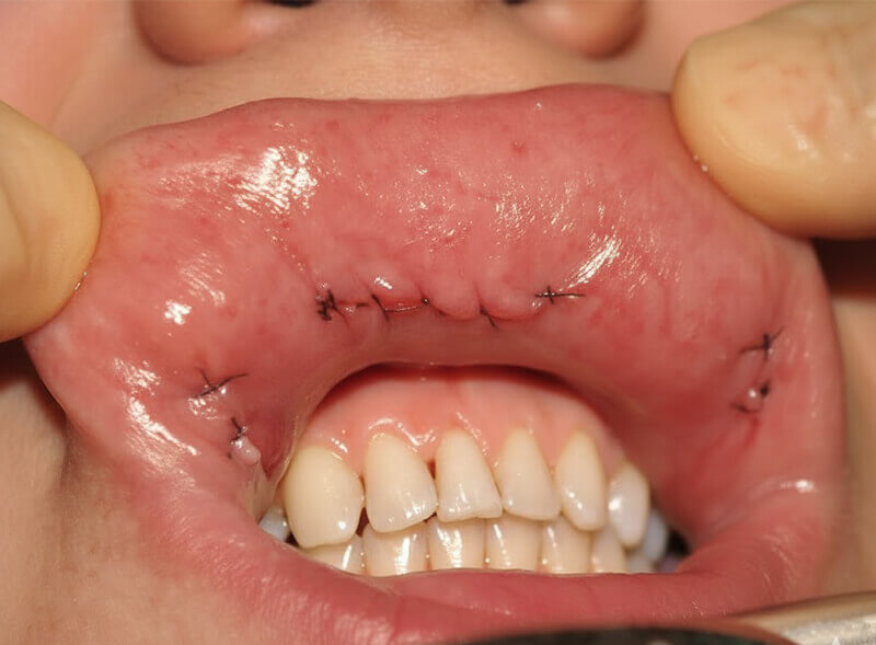 Lip sutures | PAX Medicus Medical Tourism Agency