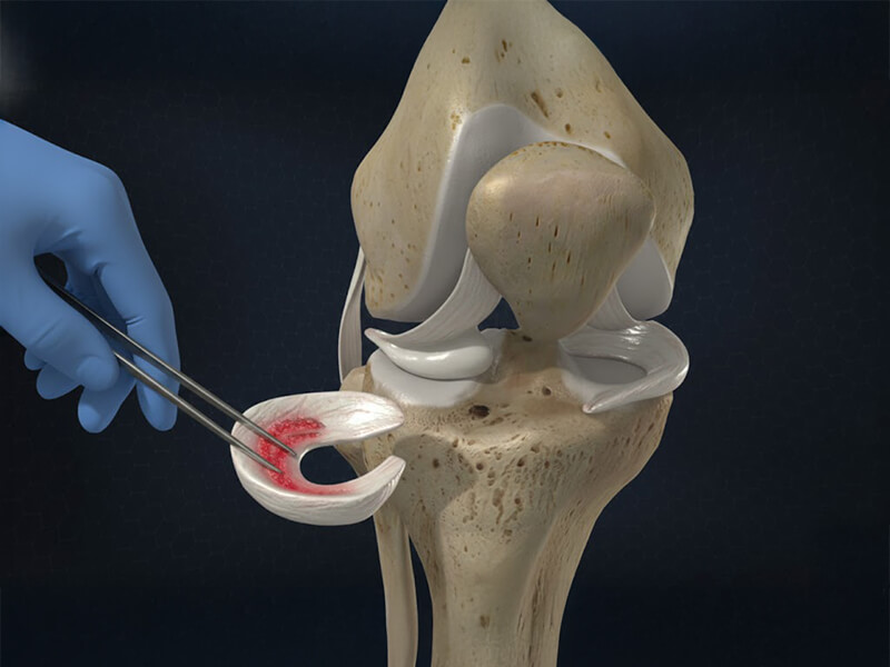 Meniscal Transplantation | PAX Medicus Medical Tourism UK