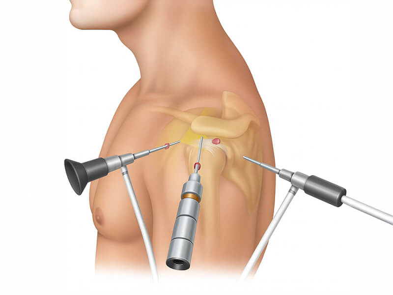 Shoulder Arthroscopy